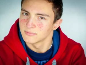 Teen Facial